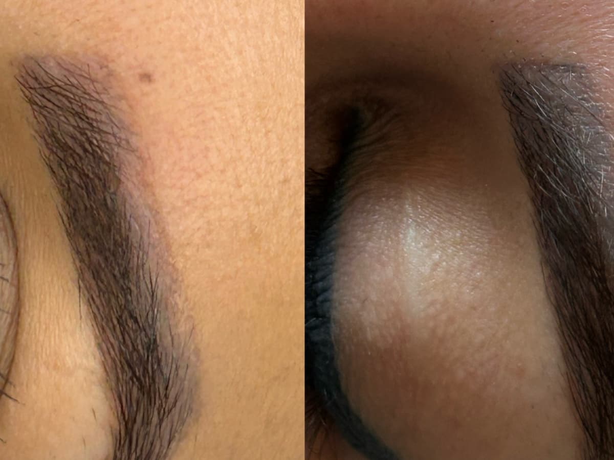 Tattoo removal